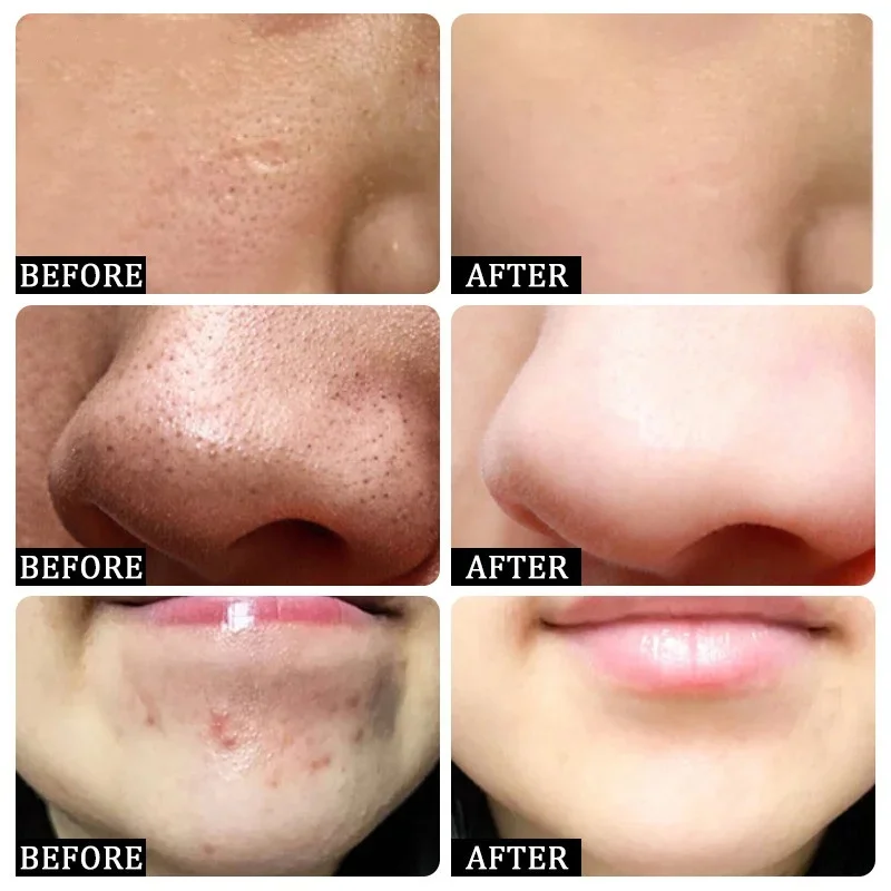 Krem z kwasem salicylowym do o – Azelaic Acid Cream recenzja i cena