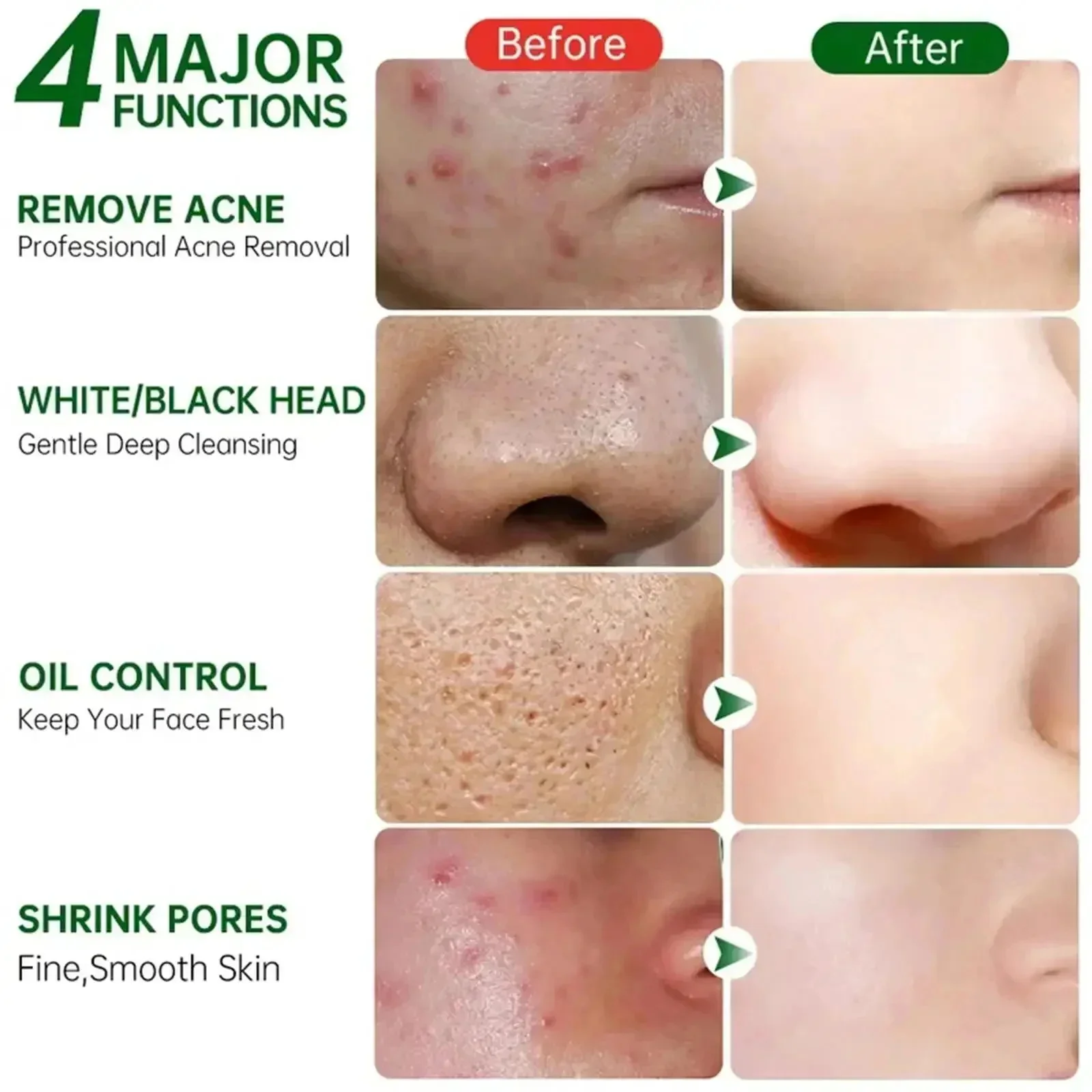 Krem z kwasem salicylowym do o – Azelaic Acid Cream recenzja i cena